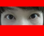 二重瞼（埋没法）の術後