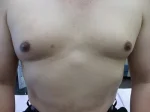 乳頭縮小（男性）