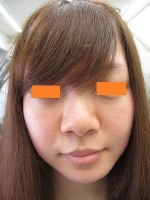 鼻翼縮小の術前