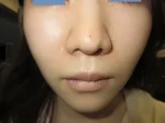鼻翼縮小の術後