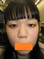 二重瞼（部分切開法）の術前