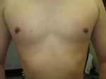 乳頭縮小（男性）の術後