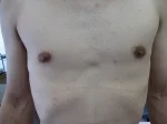 乳頭縮小（男性）の術前