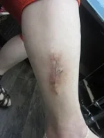 タトゥー（入れ墨）除去の術後