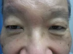 眼瞼下垂の術前
