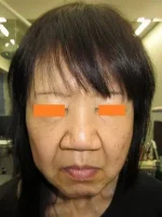 鼻翼縮小の術前