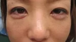 眼の下の二重の術後