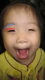 上眼瞼タルミ取り