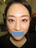 眼瞼下垂+上眼瞼タルミ取り+経結膜脱脂法の術後