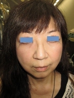 経結膜脱脂法（目の下のふくらみ取り）術後