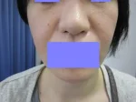 鼻翼縮小の術後