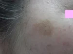 シミの治療前