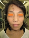 経結膜脱脂法（目の下のふくらみ取り）の術前