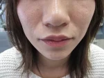 口唇　ヒアルロン酸の施注後