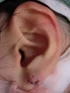 裂け耳（ピアス後の耳垂裂）の術後