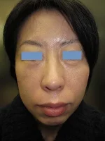 経結膜脱脂法（目の下のふくらみ取り）の術後