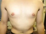 乳頭縮小（男性）の術前