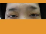 眼瞼下垂の術前