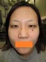 眼瞼下垂の術前