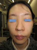 5回照射後。正面。