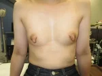 乳頭縮小（女性）の術前