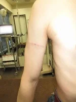 タトゥー（刺青）除去の術後