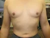 乳頭縮小（男性）の術後