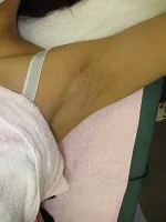 わきの傷跡修正の術後