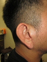 術前。右耳介。