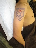 タトゥー（刺青）除去の術前