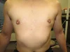 乳頭縮小（男性）（FtM）の術前