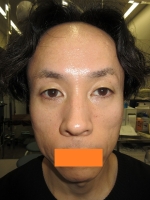 術前。正面。