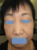 二重あごの治療（顎下の脂肪摘出術）の術後