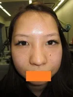 二重瞼（切開法）、目頭切開の術前