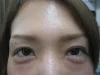 二重瞼（切開法）、眼瞼下垂の術後