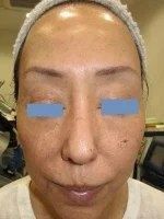 顔のイボの術後