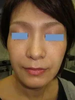 ヒアルロン酸（ほうれい線）の注入後