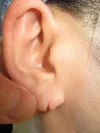 ピアス後の耳垂裂の術前