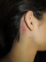 タトゥー（刺青）除去の術後