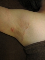 術後。右腋窩。