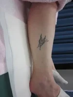 タトゥー（入れ墨）除去の術前