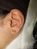 ピアスケロイドの術前