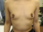 乳頭縮小（女性）の術前