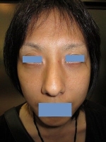 経結膜脱脂法（目の下のふくらみ取り）の術後