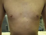 乳頭縮小（男性）の術前