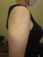 タトゥー（刺青）除去の術後