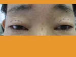 眼瞼下垂の術前