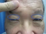 眼瞼下垂